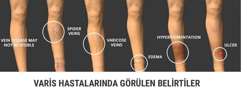 Varis nasıl anlaşılır